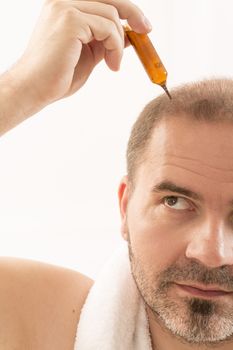 40s man with an incipient baldness , treatment, close-up, white background