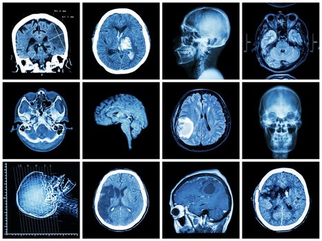 Collection of brain disease ( CT scan and MRI of brain : show cerebral infarct , intracerebral hemorrhage , brain tumor , basal ganglia hemorrhage ( status post craniotomy ) ) ( health care concept )