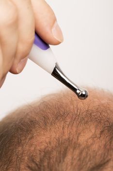 man controls hair loss stress alopecia cancer treatment