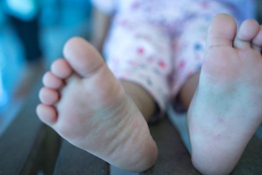 Hand foot mouth disease in child