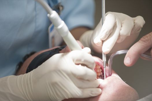 Visiting the dentist having a checkup, clean and work done. Close up images of the dentist working on and in a mouth