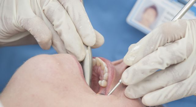 Visiting the dentist having a checkup, clean and work done. Close up images of the dentist working on and in a mouth