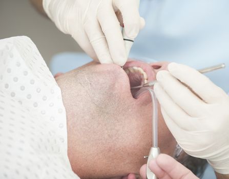 Visiting the dentist having a checkup, clean and work done. Close up images of the dentist working on and in a mouth