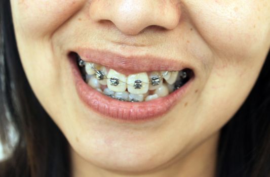 Diamond braces for teeth