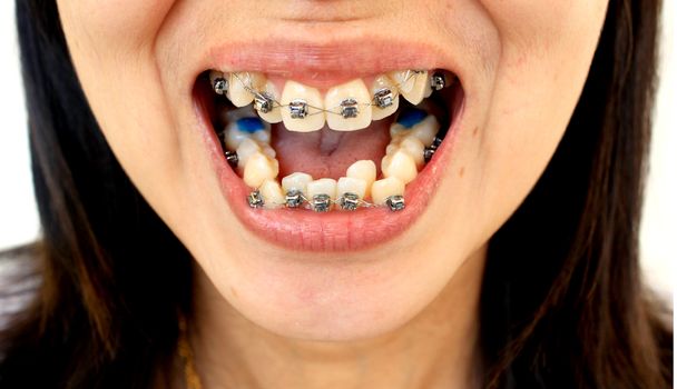 Diamond braces for teeth