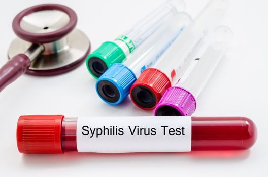 Syphilis virus blood sample collection tube with stethoscope on white background.