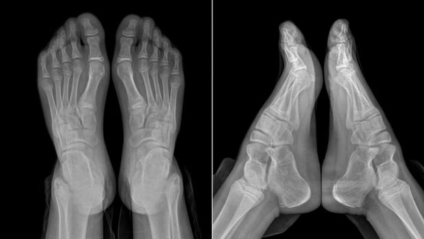 X-ray image of the girl's feet two views with partially outlined socks and trousers