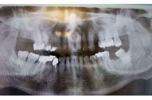 Dental X-ray. Radiograph of a human jaw.