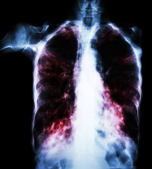 Pulmonary Tuberculosis ( film chest x-ray : interstitial infiltrate both lung due to Mycobacterium tuberculosis infection )