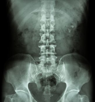 Kidney stone ( renal stone , renal calculi ) ( film x-ray KUB ( Kidney - Ureter - Bladder ) show left renal stone )