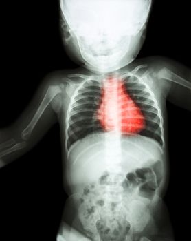 Film x-ray whole child 's body with heart disease ( Rheumatic heart disease , Valvular heart disease ) ( Cardiovascular system )