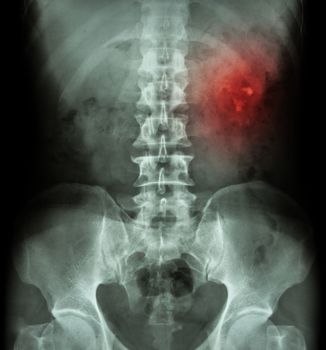 Kidney stone ( renal stone , renal calculi ) ( film x-ray KUB ( Kidney - Ureter - Bladder ) show left renal stone )