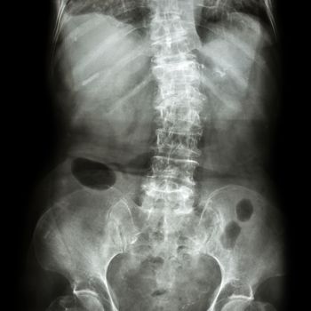 Spondylosis and Scoliosis ( film x-ray lumbar - sacrum spine show crooked spine ) ( old patient ) ( Spine Healthcare )