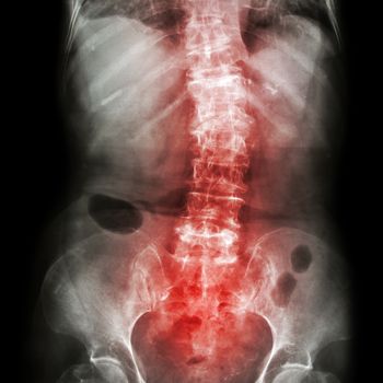 Spondylosis and Scoliosis ( film x-ray lumbar - sacrum spine show crooked spine ) ( old patient ) ( Spine Healthcare )