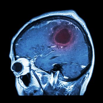 Film MRI of brain with brain tumor ( Sagittal plane , side view , lateral view ) ( Medical , Health care , Science Background )