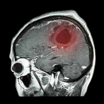 Film MRI of brain with brain tumor ( Sagittal plane , side view , lateral view ) ( Medical , Health care , Science Background )