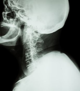 Cervical spondylosis . Film x-ray of cervical spine ( lateral position ) ( side view )