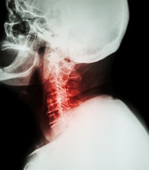 Cervical spondylosis . Film x-ray of cervical spine ( lateral position ) ( side view )