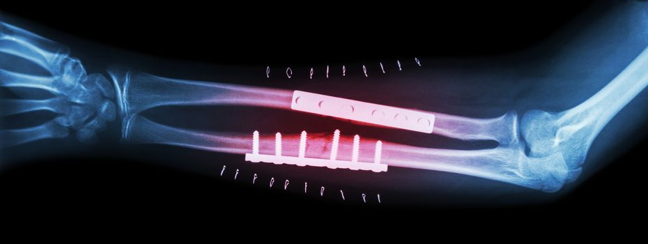 Fracture both bone of forearm ( ulnar and radius ) . It was operated and internal fixed by plate and screw