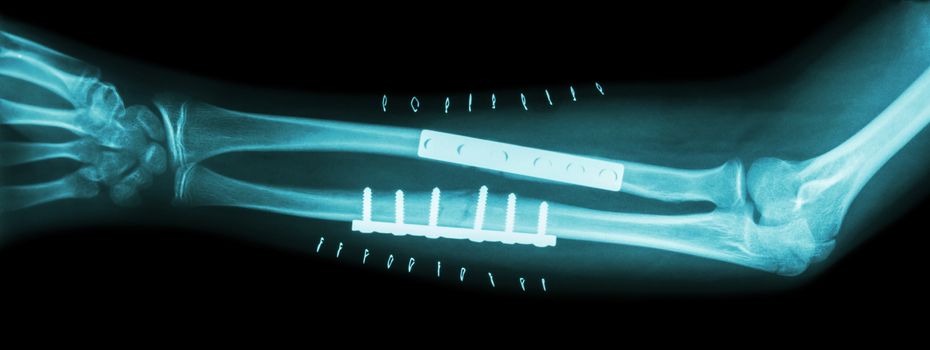 Fracture both bone of forearm ( ulnar and radius ) . It was operated and internal fixed by plate and screw