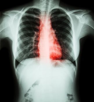 Heart disease ( Film chest x-ray of woman with heart disease )