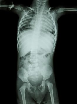 Film X-ray whole body of child ( Medical , Science and Healthcare concept )