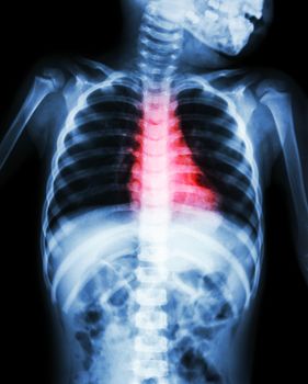 Congenital Heart Disease , Rheumatic Heart Disease ( X-ray body of child and red color on heart area )