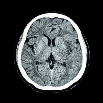 CT scan of brain : show normal human 's brain ( CAT scan )