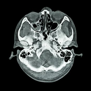 CT scan of brain and base of skull ( Bone window )