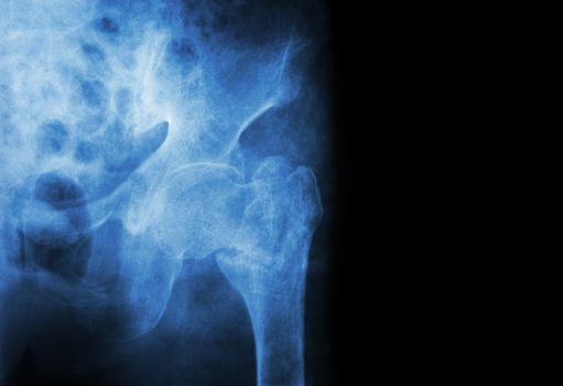 intertrochanteric ( Neck of femur ) fracture left femur ( Thigh bone ) and blank area at right side