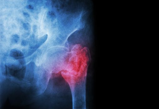 intertrochanteric ( Neck of femur ) fracture left femur ( Thigh bone ) and blank area at right side