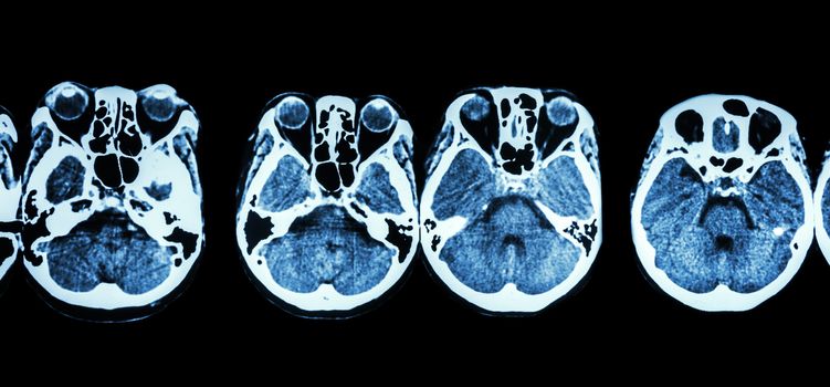 CT scan of brain and base of skull ( show structure of eye , ethmoid sinus , cerebellum , cerebrum, etc )