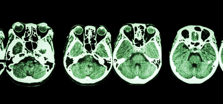 CT scan of brain and base of skull ( show structure of eye , ethmoid sinus , cerebellum , cerebrum, etc )