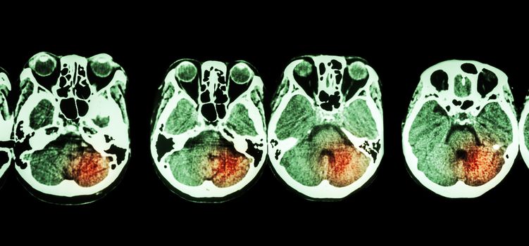 Stroke ( CT scan of brain and base of skull and Stroke )