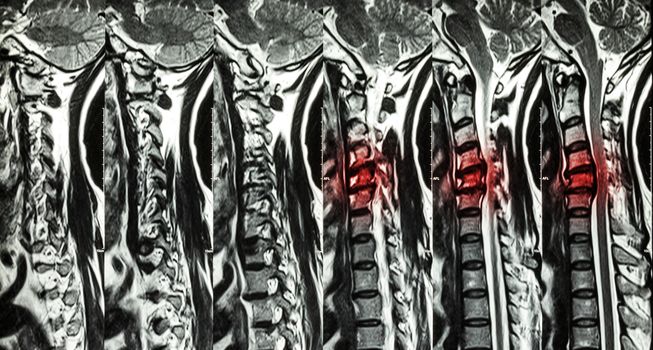 Cervical spondylosis with disc herniation ( MRI of cervical spine : show cervical spondylosis with disc herniation compress spinal cord ( Myelopathy ) )