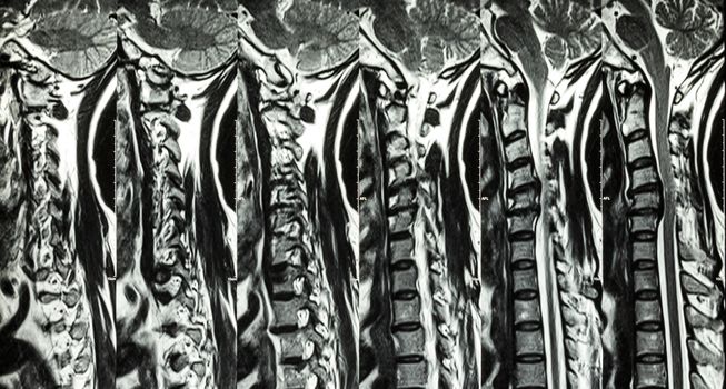 Cervical spondylosis with disc herniation ( MRI of cervical spine : show cervical spondylosis with disc herniation compress spinal cord ( Myelopathy ) )