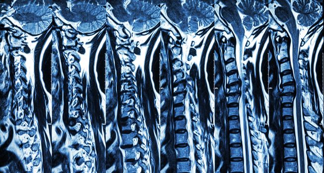 Cervical spondylosis with disc herniation ( MRI of cervical spine : show cervical spondylosis with disc herniation compress spinal cord ( Myelopathy ) )