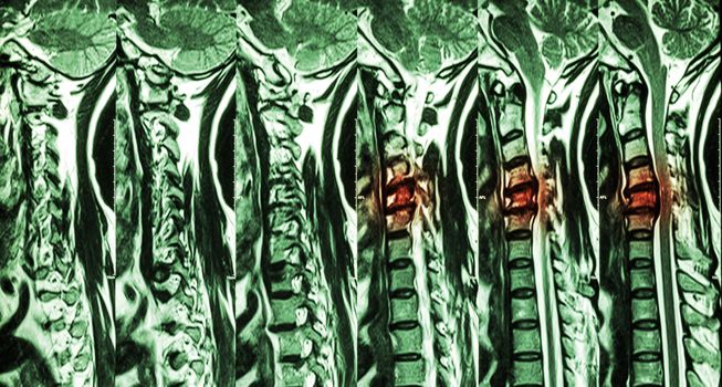 Cervical spondylosis with disc herniation ( MRI of cervical spine : show cervical spondylosis with disc herniation compress spinal cord ( Myelopathy ) )