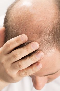 Baldness Alopecia man hair loss medicine bald treatment transplantation France