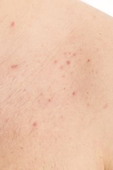 acne on mature  male back treatment infection