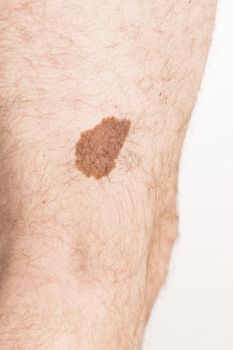 Melanoma angioma beauty mark spot on man skin France