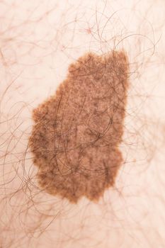 Melanoma angioma beauty mark spot on man skin France