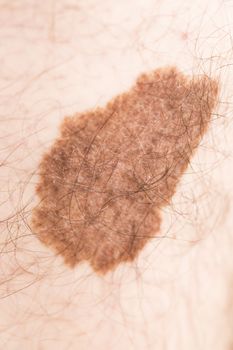Melanoma angioma beauty mark spot on man skin France
