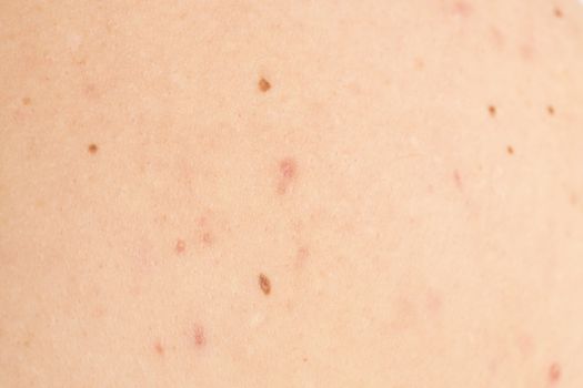 acne on mature  male back treatment infection