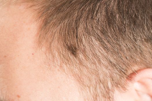 Melanoma angioma beauty mark spot on man head face France