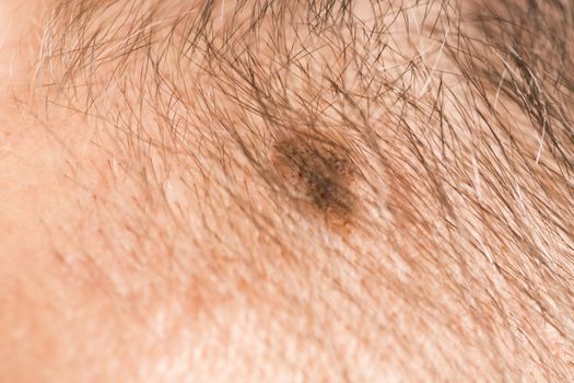 Melanoma angioma beauty mark spot on man head face France