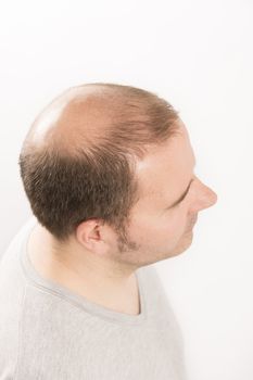 Baldness Alopecia man hair loss haircare medicine bald treatment transplantation