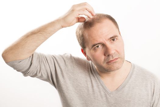 Baldness Alopecia man hair loss haircare medicine bald treatment transplantation