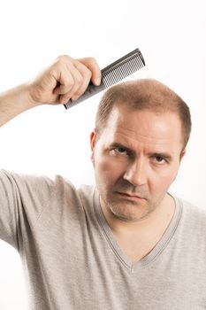 Baldness Alopecia man hair loss haircare medicine bald treatment transplantation