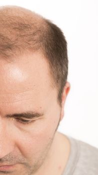 Baldness Alopecia man hair loss haircare medicine bald treatment transplantation